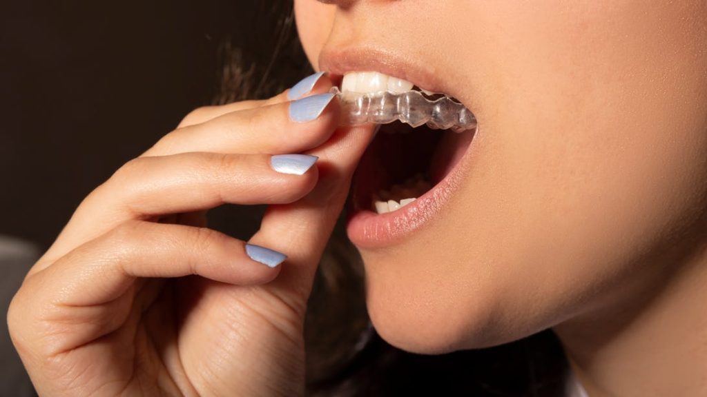 best invisible braces of 2026